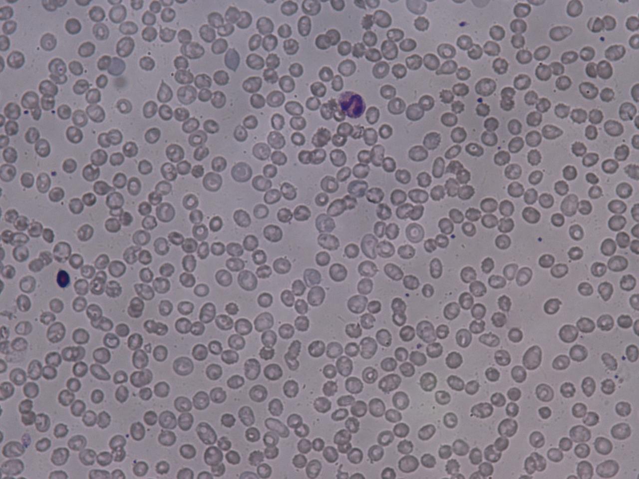 Paroxysmal Nocturnal Hemoglobinuria Blood Smear